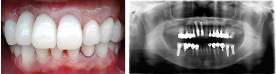 インプラント治療例